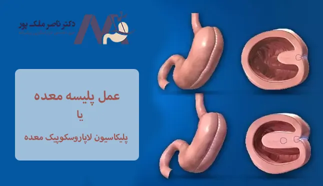 عمل-پلیسه-معده
