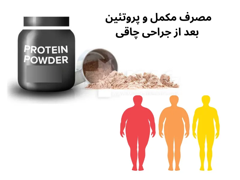 مصرف مکمل و پروتئین بعد از جراحی چاقی برای بدن ضروری است.