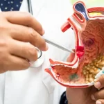 خطرات و عوارض احتمالی برداشتن کیسه صفرا