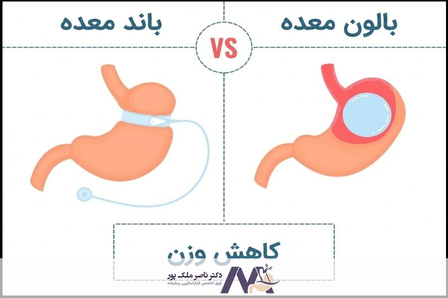 حلقه معده بهتر است یا بالن