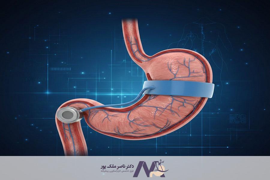 لاغری با حلقه معده