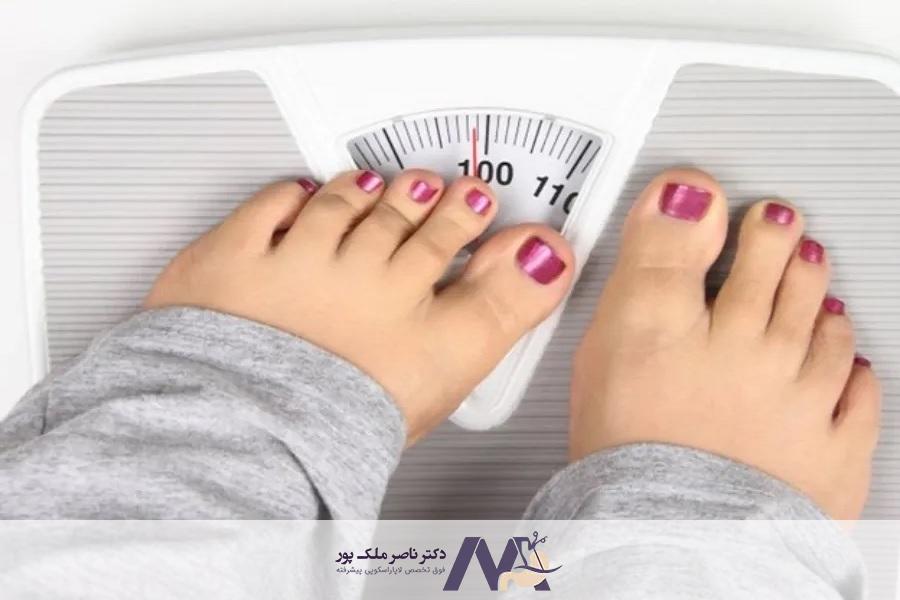 بازگشت وزن بعد از بای‌ پس معده