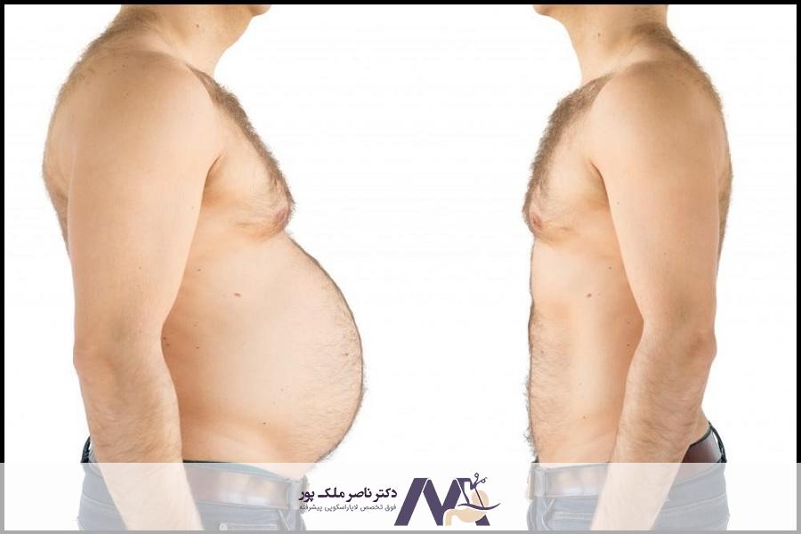 مزایای جراحی اسلیو معده