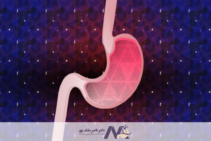 مزایای جراحی اسلیو معده