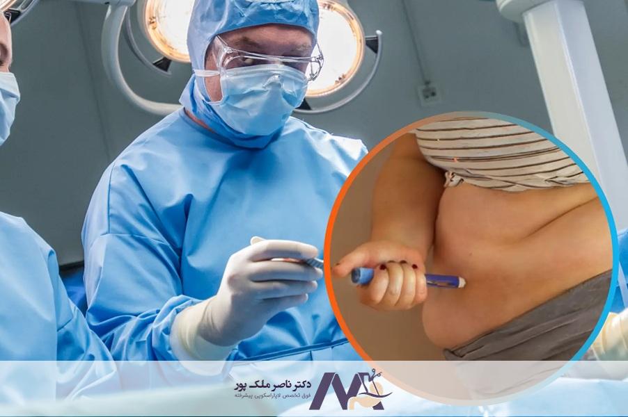 جراحی لاغری برای دیابت