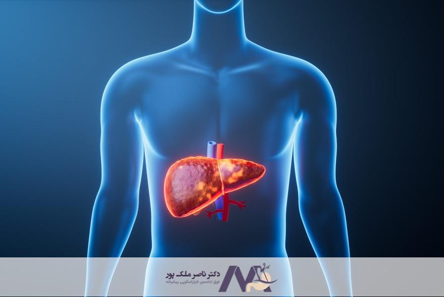 جراحی لاغری برای کبد چرب