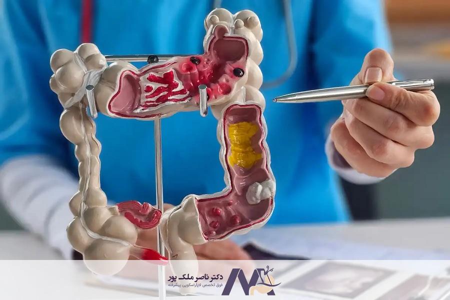 مهم ترین علائم سرطان روده