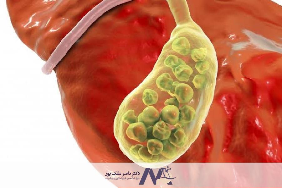 علائم پر شدن کیسه صفرا