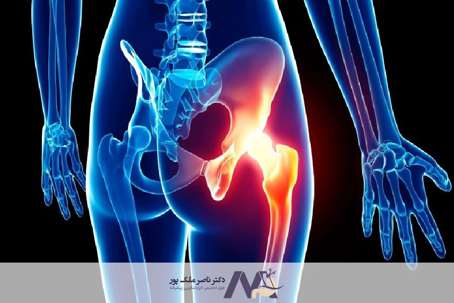 علائم فتق کشاله ران در زنان
