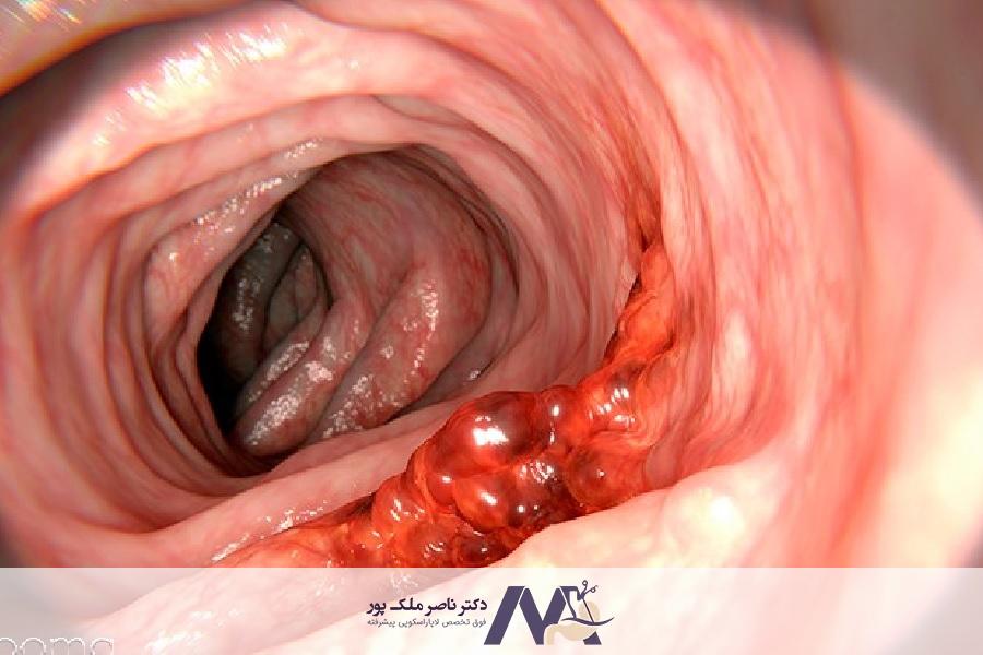 مهم ترین علائم سرطان روده