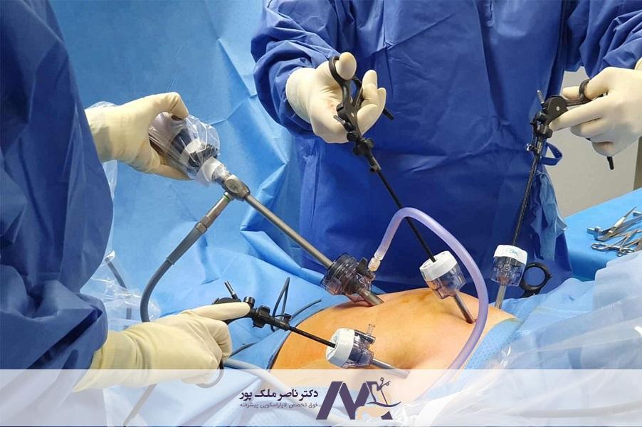 عمل فتق با لاپاراسکوپی یا عمل باز