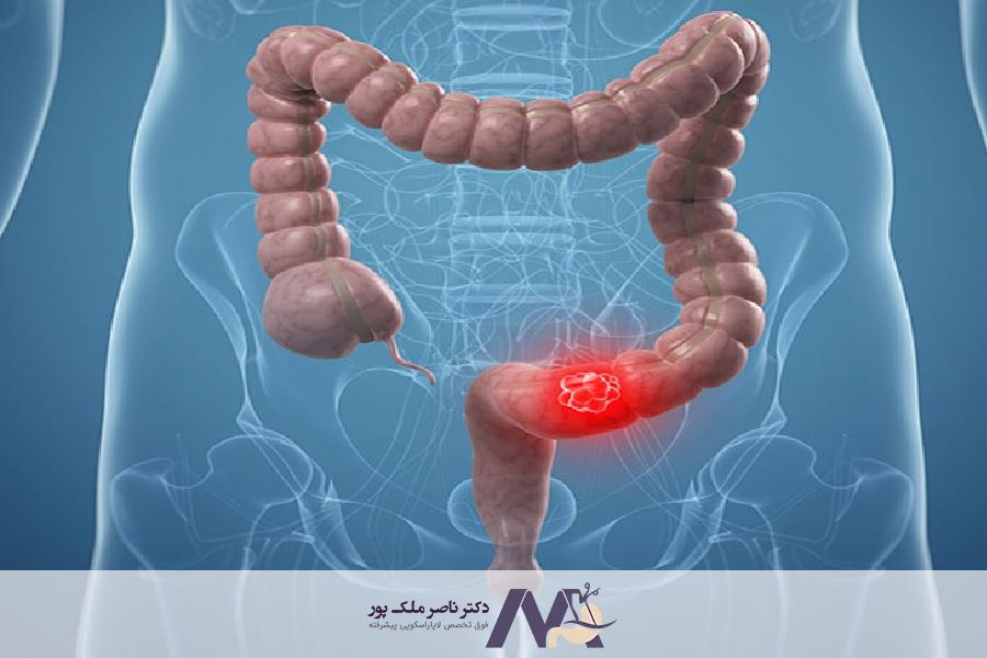 مهم ترین علائم سرطان روده
