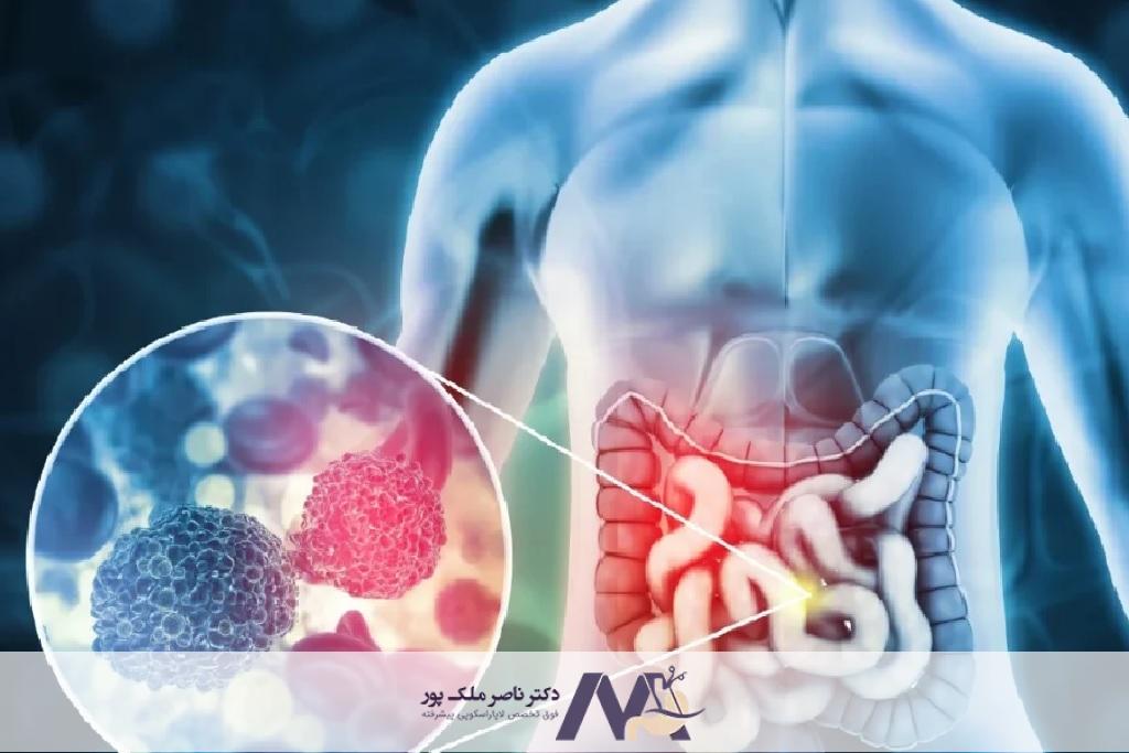 مهم ترین علائم سرطان روده