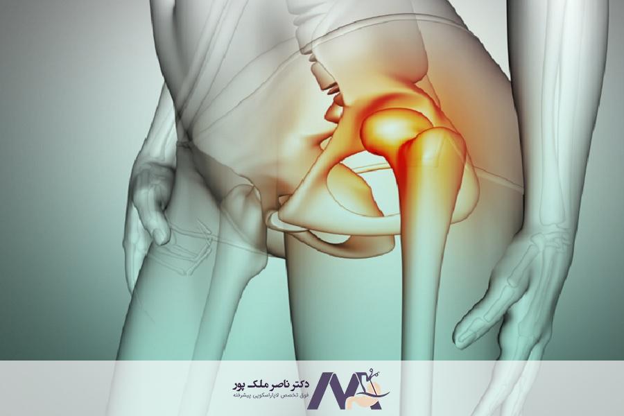 علائم فتق کشاله ران در زنان