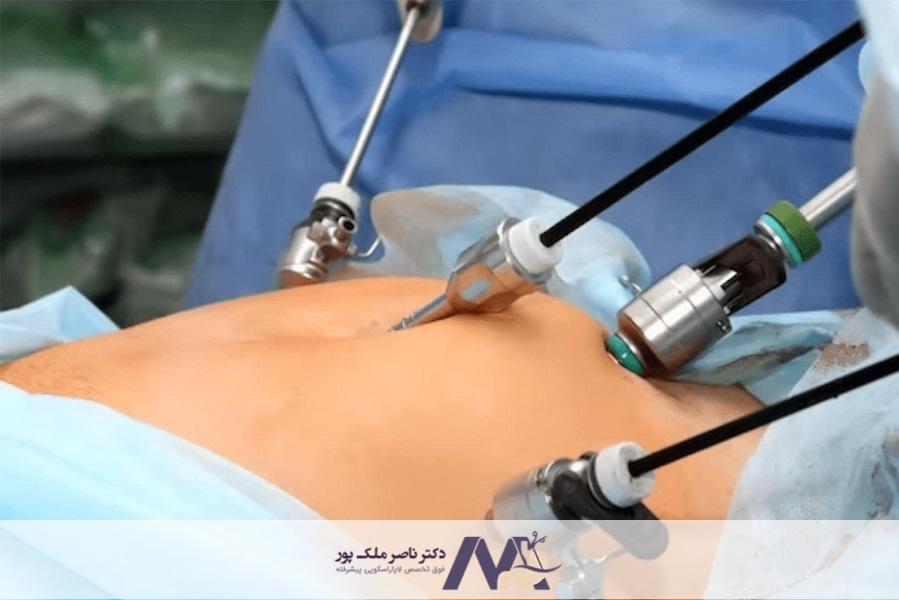 عمل فتق با لاپاراسکوپی یا عمل باز