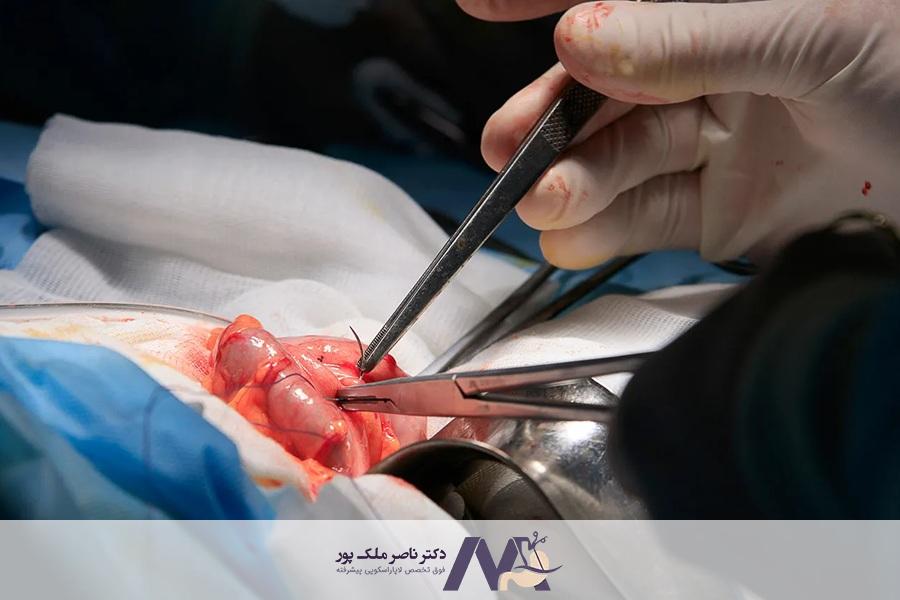هزینه جراحی روده