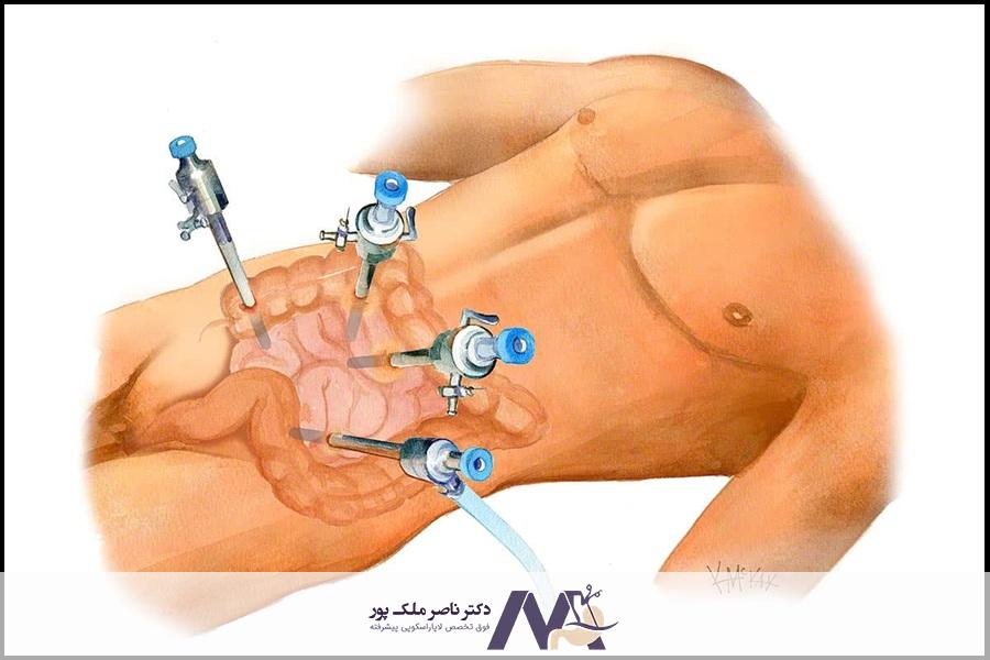 جراحی لاپاراسکوپی کولورکتال