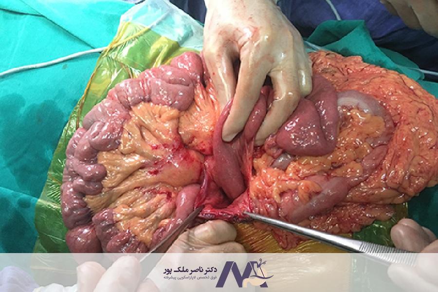 آناستوموز روده