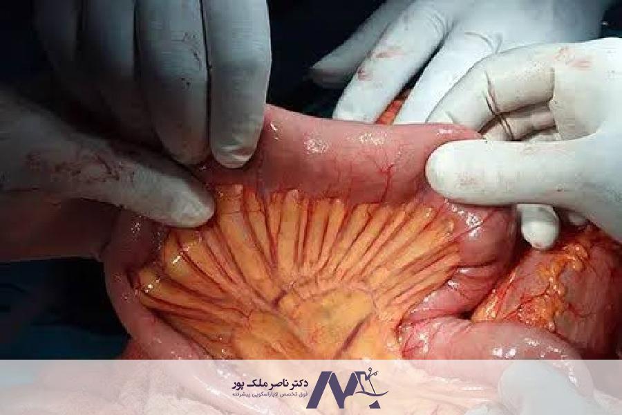 آناستوموز روده