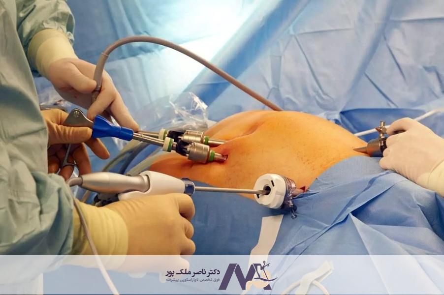 هزینه جراحی روده